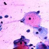Prostate cancer may be sexually transmitted