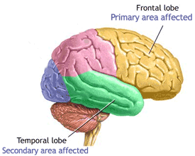 Protein against Alzheimer's disease?