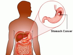 Protein discovered to prevent stomach cancer from spreading
