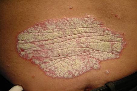 Psoriasis easily leads to stroke