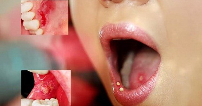 Quick tips for treating mouth ulcers quickly