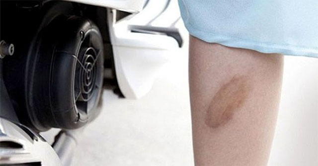 Quick treatment of burns without scarring