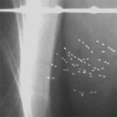 Radioactive particles can treat the root of breast cancer