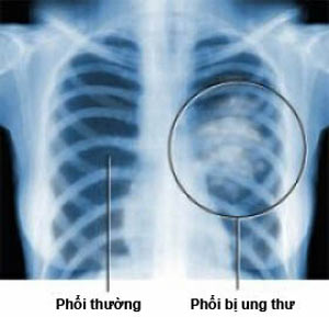Radiotherapy in the brain: Better treatment for lung cancer
