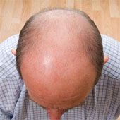 Random discovery brings good news to bald people