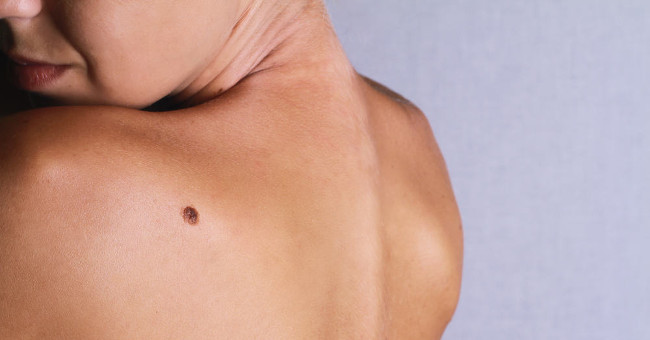 Rare cancer hidden behind moles