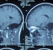 Rare cases: People born without cerebellum