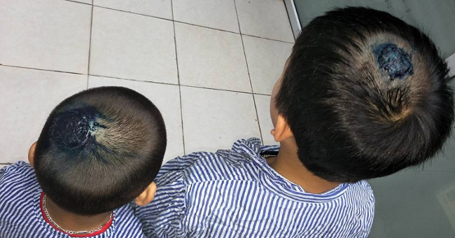 Rare disease: The head has a honeycomb because of playing with cats and dogs