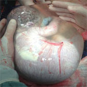 Rare picture of babies born in amniotic sac