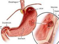Recognize stomach ulcers