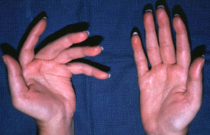 Recovering damage caused by multiple sclerosis