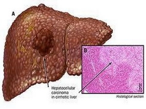 Relationship between hepatitis B and lymphoma