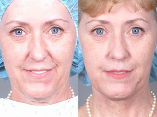Remove facial wrinkles with low energy plasma method