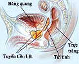 Removing the prostate gland easily causes impotence