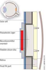 Restore vision with new implant techniques