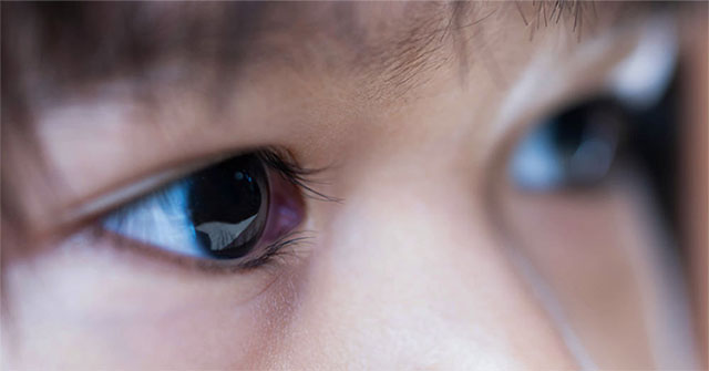 Retinoblastoma: Causes, symptoms, diagnosis and treatment
