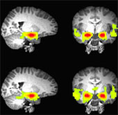 Revealing the secret of a spoiled teenage brain