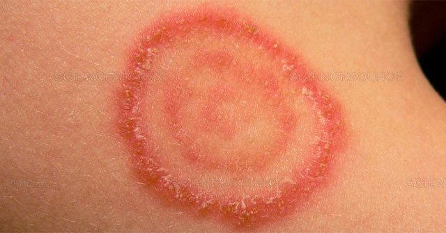 Ringworm: Causes, symptoms and treatment