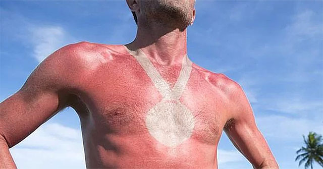 Risk of skin cancer from summer day game 'sunburn tattoo'