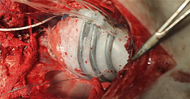 Robots help patients with heart failure through critical attacks