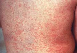 Rubella symptoms appear in Hoc Mon