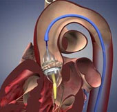 Russia successfully assembled the latest artificial heart valve model