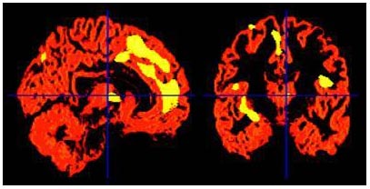 Sad memories change the amount of gray matter in the brain