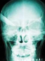 Save the life of the brain pierced