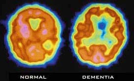 Scanning the brain can help diagnose Alzheimer's early