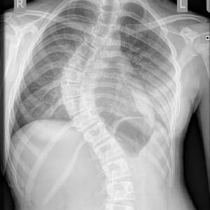 Schoolgirl has a 90 degree scoliosis