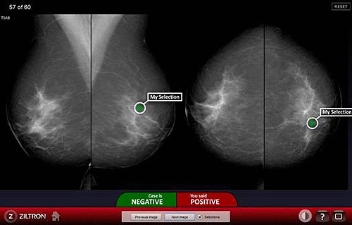 Screening program for early detection of breast cancer