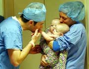 Separating a conjoined twins