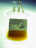 Serum disease can be fatal