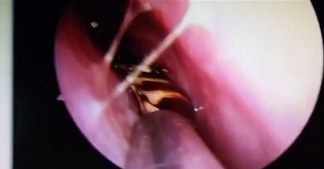 Severe shock when detecting cockroaches living in the skull