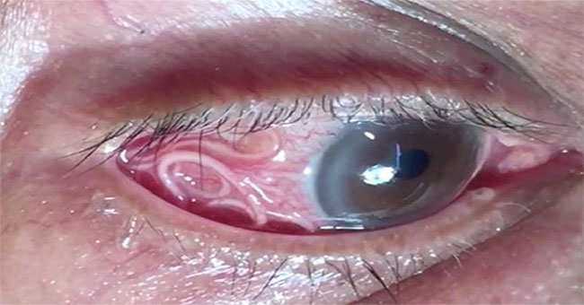 Shivered by the doctor 'catching' parasitic worms from the human eye