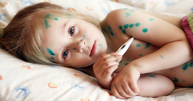 Signs and ways to take care of chickenpox patients