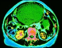 Signs of ovarian cancer are often confused