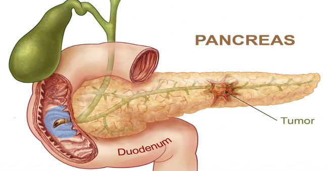 Signs of risk of pancreatic cancer