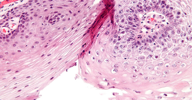 Signs of warts and treatment