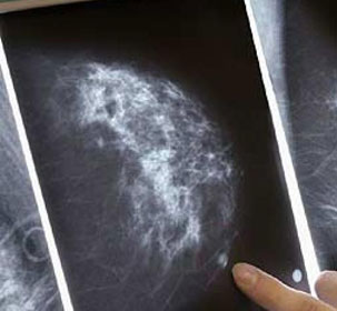 Similarities between breast and ovarian cancer