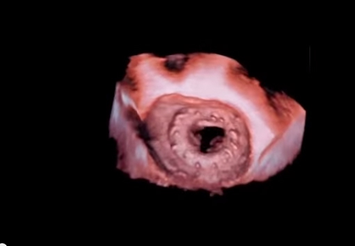 Simulating the active heart in the human body