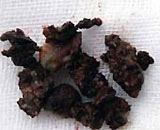 Sinus mushroom - hidden killer