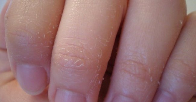 Skin diseases in the cold season are easy to relapse
