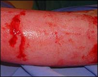 Skin regeneration from genetically modified cells