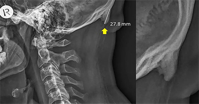 Skull 'sprouting' spikes suspected by smartphone addiction