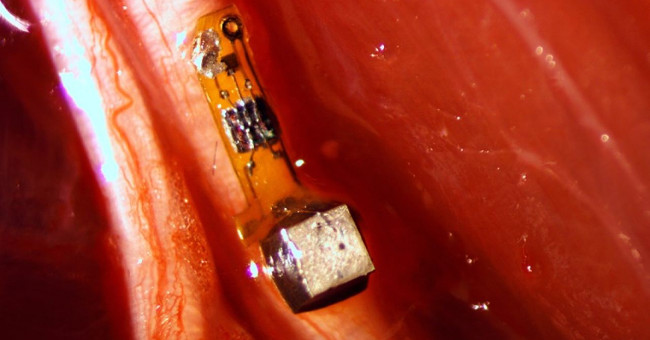 Smart dust - Micro sensor implanted in the brain, real-time monitoring
