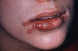 Soft tissue lesions in children