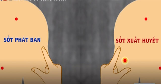 Some signs distinguish dengue and typhus