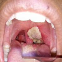 Sore throat: Very dangerous manifestations of diphtheria are outbreaks
