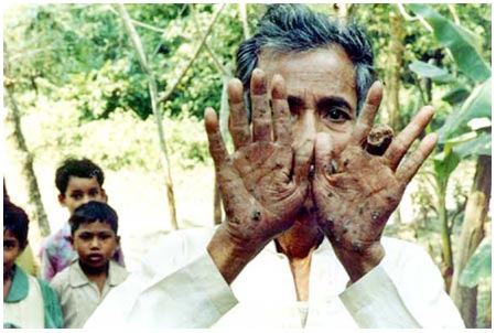 Southeast Asia has a high rate of arsenic poisoning in the country